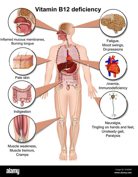 Top 167+ Vitamin b12 deficiency animation - Merkantilaklubben.org