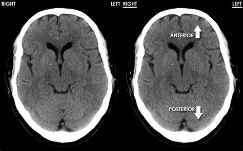 Spect Ct Scan Brain Ct Scan Machine