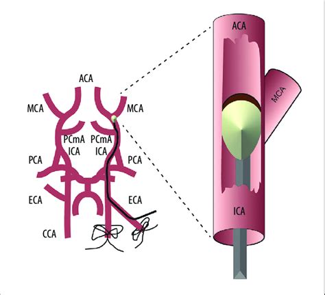 Medial Cerebral Artery | Hot Sex Picture