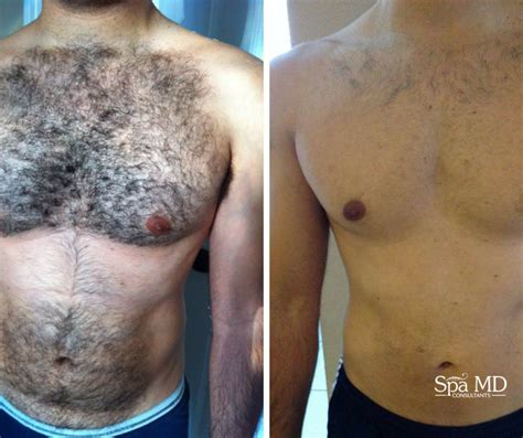 Laser Hair Removal for Men - Spa MD