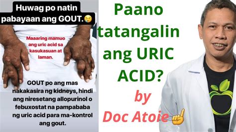 URIC ACID Paano pagagalingin by Doc Atoie Arboleda 💛 - YouTube