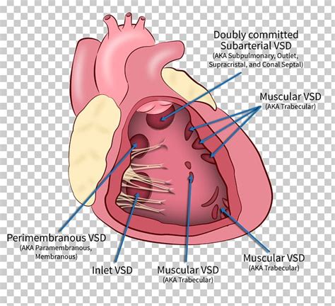 Heart Ventricular Septal Defect Interventricular Septum Ventricle PNG, Clipart, Abdomen, Anatomy ...