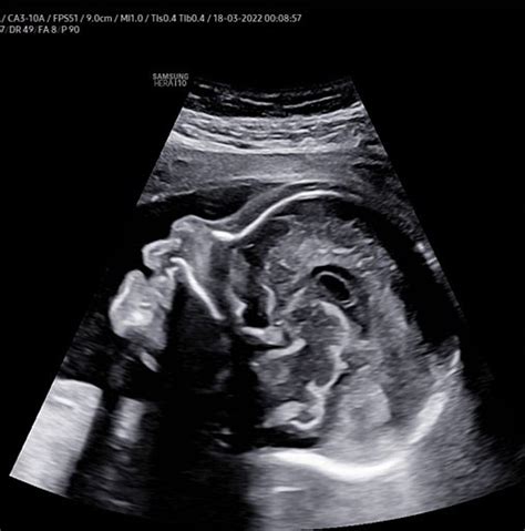 Ultrasound Evaluation of Normal Second-Trimester Fetal Anatomy ...