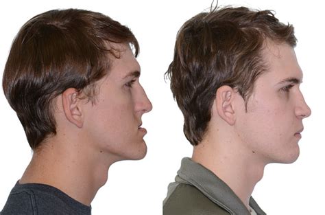 Double Jaw Orthognathic Surgery - Corrective Jaw Surgery - Dr. Antipov