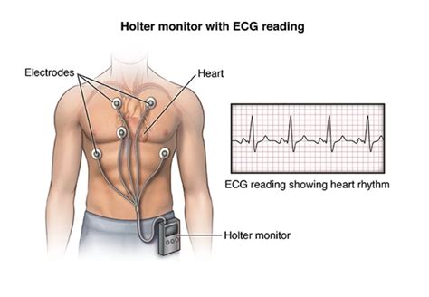 Holter monitor results example - Lady and Care