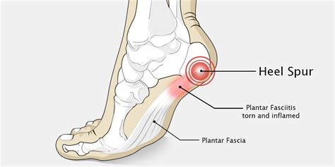 Heel Pain: Causes, Prevention, and Treatments in Houston – Foot Houston