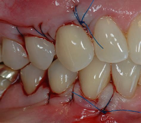 Gum Recession Case Study - Mary - Portland Perio Implant Center