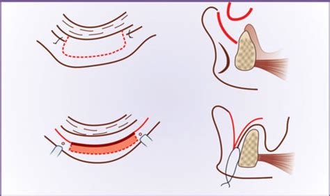 What is Vestibuloplasty? | News | Dentagama