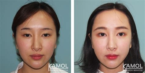 Cheekbone Reduction / Zygoma reduction | Kamol Cosmetic Hospital