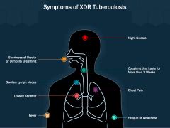 XDR Tuberculosis PowerPoint and Google Slides Template - PPT Slides