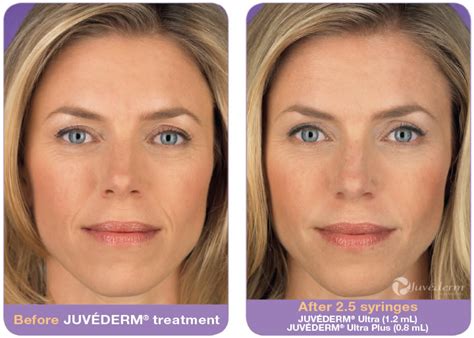 Is Juvéderm Better Than Botox For Wrinkles? | Metrolina Medical Associates