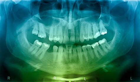 Xray Of Human Mouth Stock Photo - Download Image Now - iStock