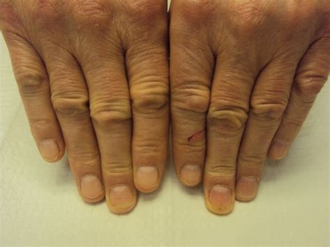 Dupuytren's: Knuckle Pads: Dorsal Dupuytren Nodules