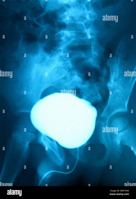 Retrograde cystography Stock Photo - Alamy