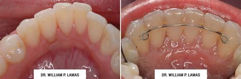 Periodontal Plastic Surgery Before & After Photos - Dr. William Lamas