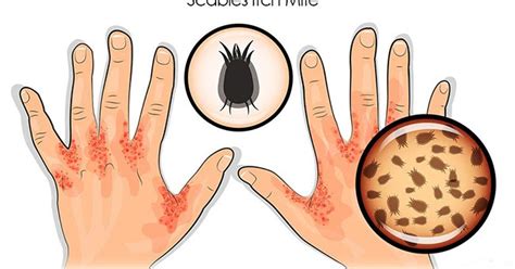 Ayurvedic Treatment for Scabies / Skin Mites - Symptoms, Causes, Diagnosis & Herbal Remedies ...