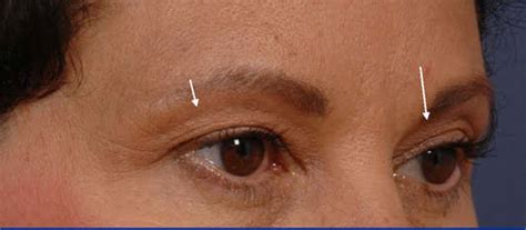 Eyelid Thermage Before and After Pictures | Santa Monica Laser and Skin Care Center