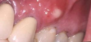 Pimple on Gums - Pictures, Causes, Prevention & Home Remedy