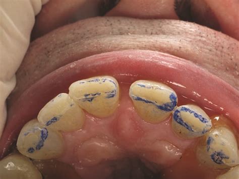 Show Your Work: Treating Incisal Edge Wear by Dr. Marvin Fier - Dentaltown