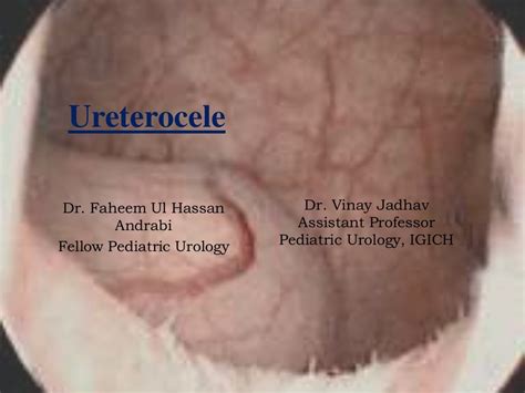 Ureterocele - Pictures