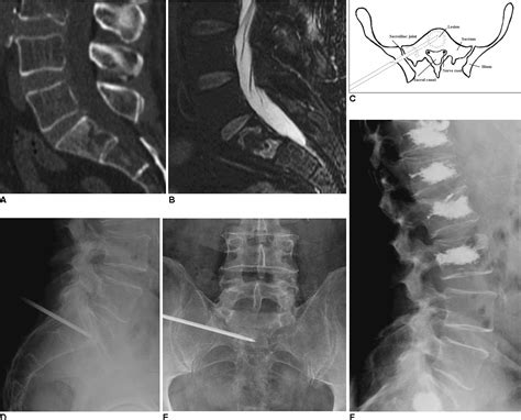 Figure 1 from Percutaneous Sacroplasty for Sacral Metastatic Tumors Under Fluoroscopic Guidance ...