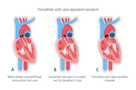 Free clip swelling hearts, Download Free clip swelling hearts png images, Free ClipArts on ...