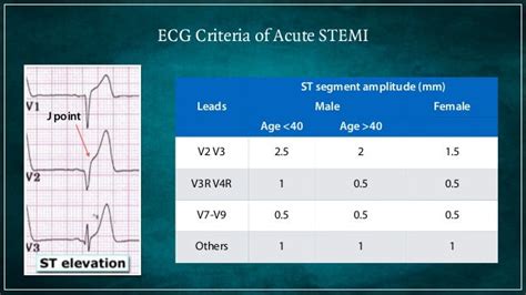 Electrocardiogram