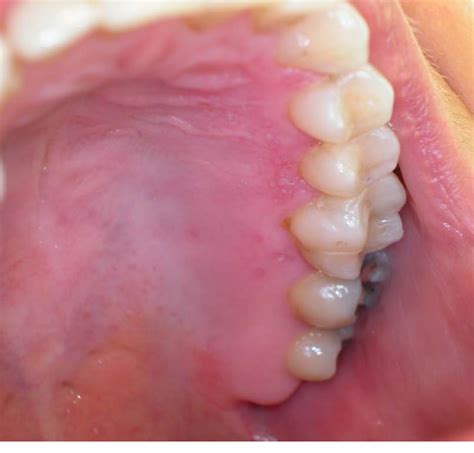 Figure 3 from HERPES SIMPLEX VIRUS (HSV) INFECTION OF THE MOUTH Definition | Semantic Scholar