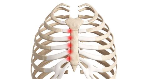 Costochondritis (Tietze's Syndrome) - Sportsinjuryclinic.net