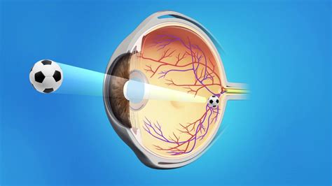 Cataract Surgery with a Toric Lens - YouTube