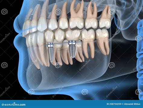 Recovery with Dental Implants. Medically Accurate 3D Illustration of ...