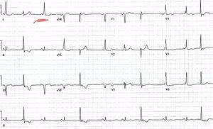 Premature Junctional Complex