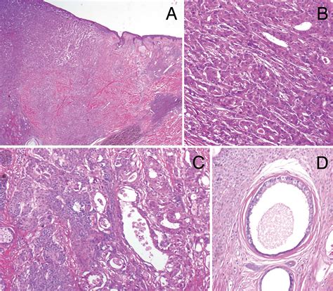 Primary cutaneous apocrine carcinoma arising within a congenital nevus ...