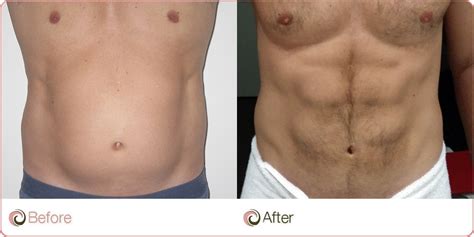 The Types of Liposuction Cost - Weight Loss Surgery