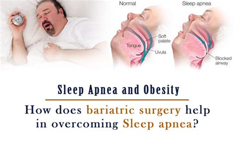 How does bariatric surgery help in overcoming Sleep apnea?