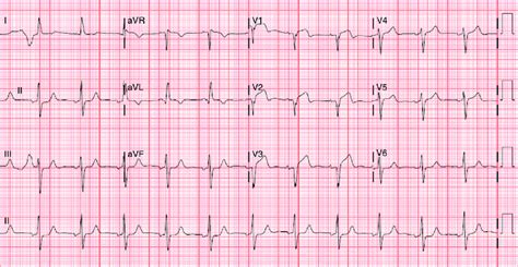 EKG at presentation showing ectopic atrial rhythm with ST elevations in... | Download Scientific ...