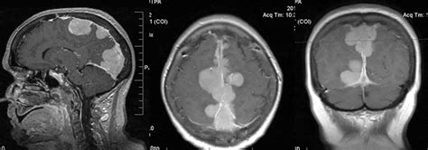 Case 3) T1-weighted images with contrast showing a superior sagittal ...