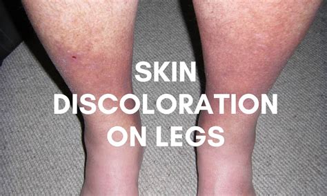 Skin Discoloration On Legs: Causes, Types & Treatments