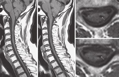 Figure1.Abnormal MRI findings. A: Cerebellar tonsils are displaced... | Download Scientific Diagram