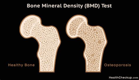 Bone Mineral Density Test for Osteoporosis | Signs,Symptoms of Osteoporosis