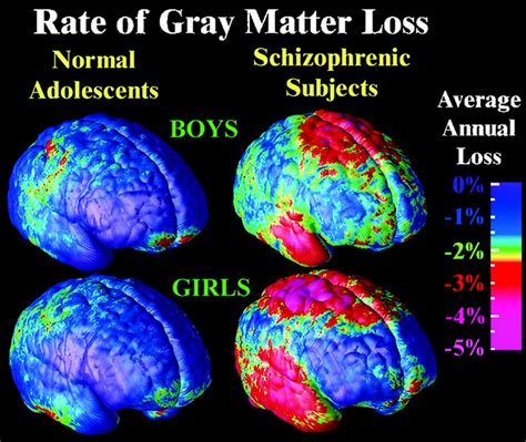 Environmental Factors - Schizophrenia