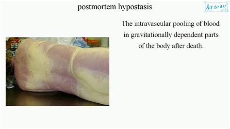 postmortem hypostasis (English) - Medical terminology for medical ...