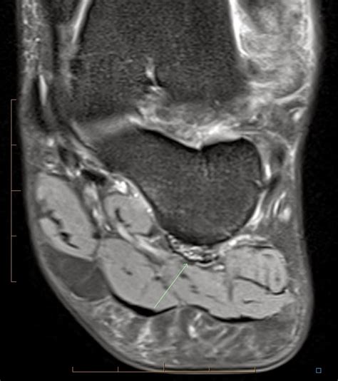 Radiology Cases: Long Plantar Ligament Sprain