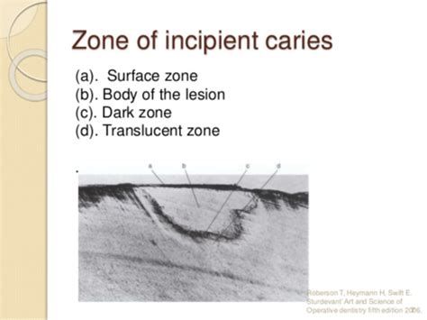 Topic 22 the clinical aspect and histology of incipient caries: Flashcards | Quizlet