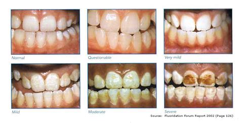 Health Effects of Fluoride: Day 3: Dental Fluorosis