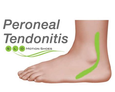 Peroneal Tendon Injuries - SLO Motion ShoesSLO Motion Shoes