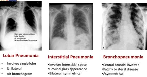 Pneumonia Chest X Ray Interpretation