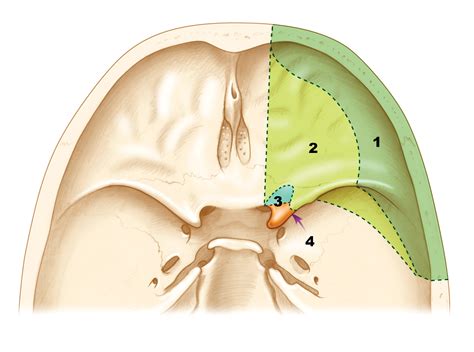 Orbitozygomatic approaches – Skull Base Surgery Atlas