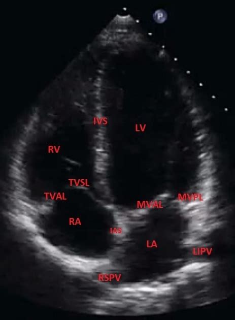 Normal Echocardiogram