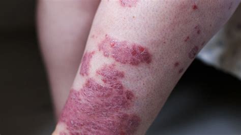 What Does A Psoriatic Arthritis Rash Look Like - ZOHAL